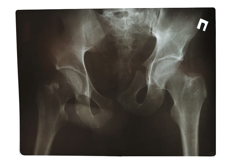 Pelvic_fracture