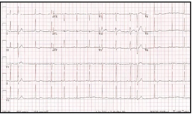 ECG