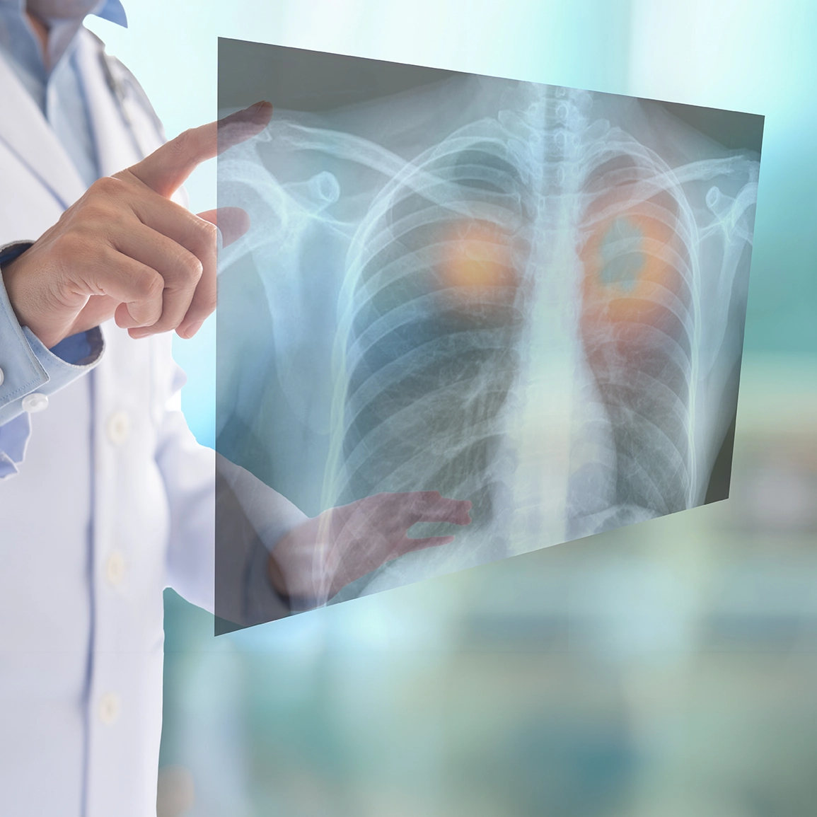 NNPneumonia_1544153984